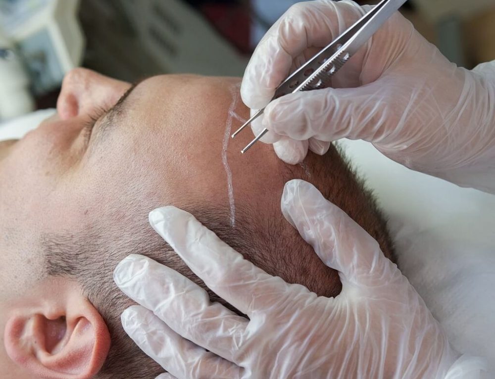 Facial hair transplantation