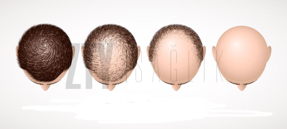 Fut Hair Transplant Turkey Cost 2024 Zty Health Istanbul