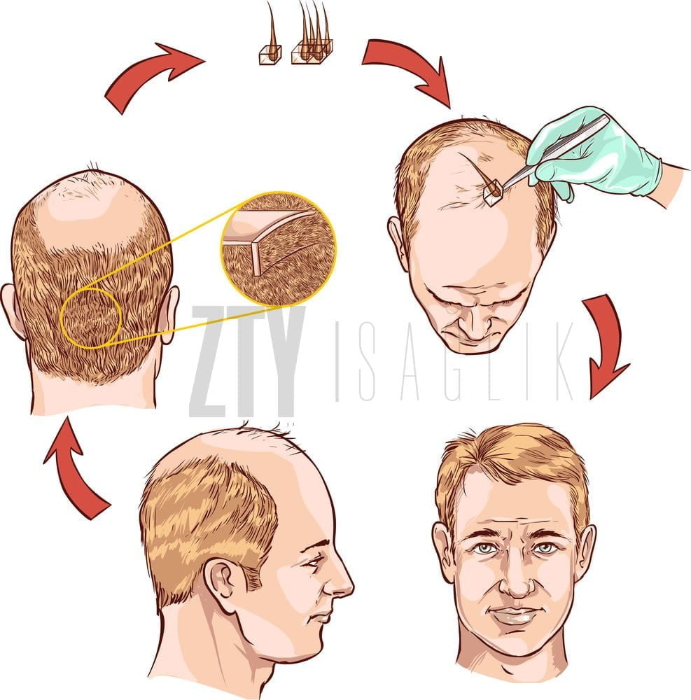 9 months after HAIR TRANSPLANT IN TURKEY with lots of PICS, no more  MINOXIDIL? aged 44 - YouTube