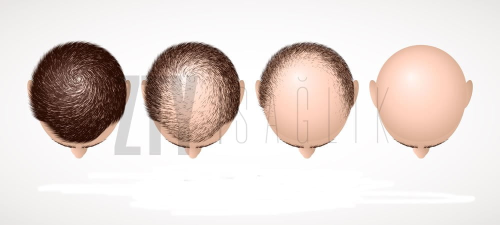 Trasplante de cabello FUT en Turquía