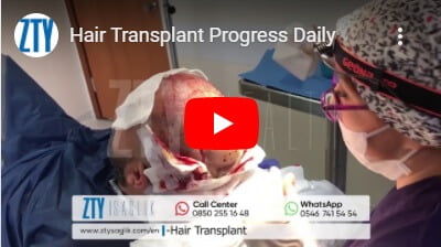 hair transplant turkey -1