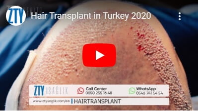 hair transplant turkey -2