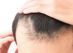 Quelle est la différence entre la greffe de cheveux FUE et FUT ?