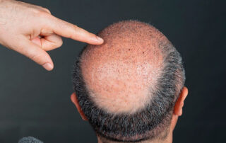 What is the difference between FUE and FUT hair transplantation