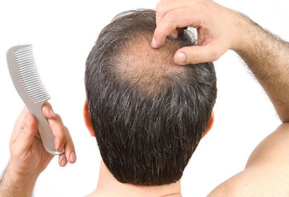 Les raisons de la perte de cheveux chez les hommes