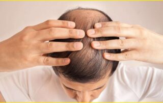 Patients-at-Risk-of-Baldness-Zty-Health-1024x576