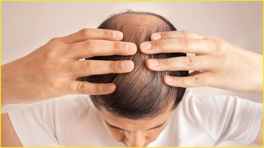 Patients at Risk of Baldness
