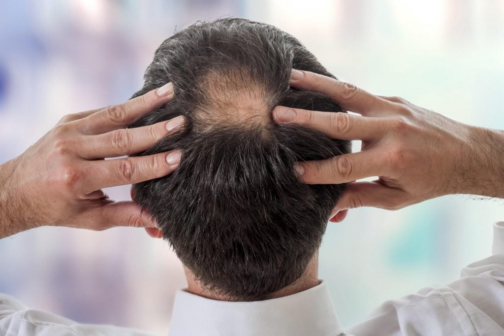 Puede el trasplante de cabello causar una lesión nerviosa
