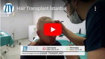 Trapianto capelli in Turchia-3