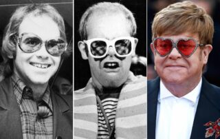 El trasplante de cabello de Elton John