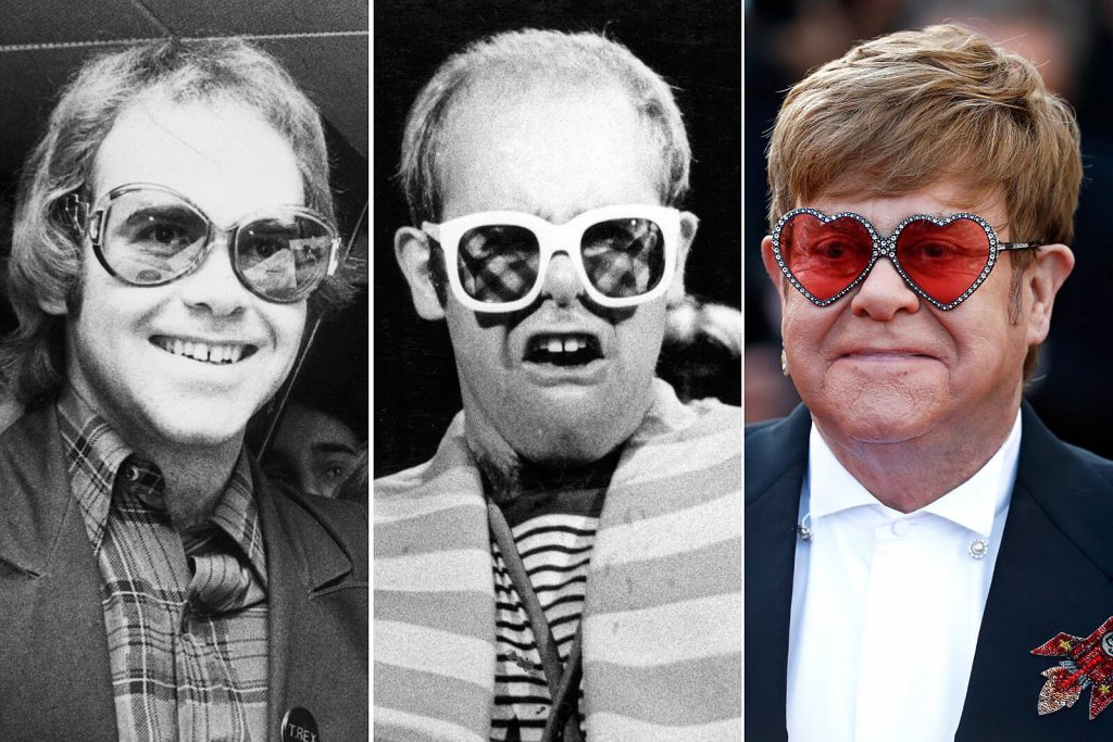 La greffe de cheveux d'Elton John