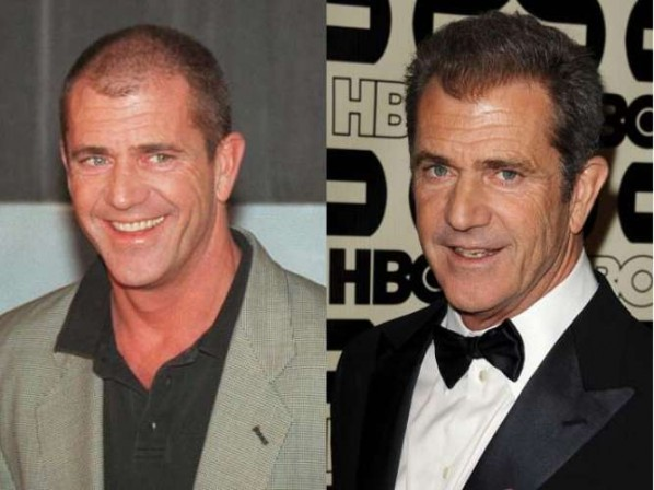 Trasplante de cabello de Mel Gibson
