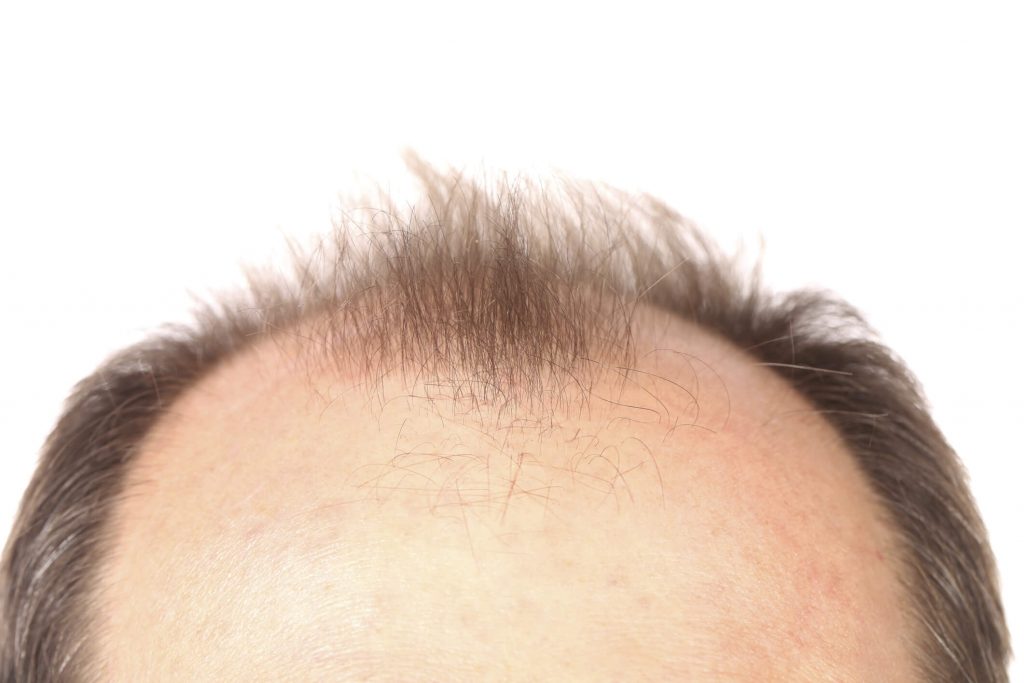 Wie lange dauert eine Haartransplantation?