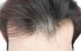 Cómo reconoces el adelgazamiento del cabello
