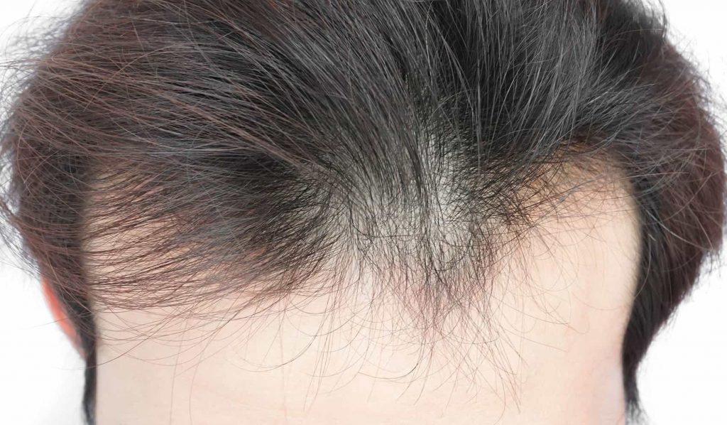 Cómo reconoces el adelgazamiento del cabello