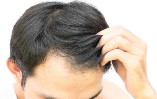 Haarausfall aufgrund von Eisenmangel