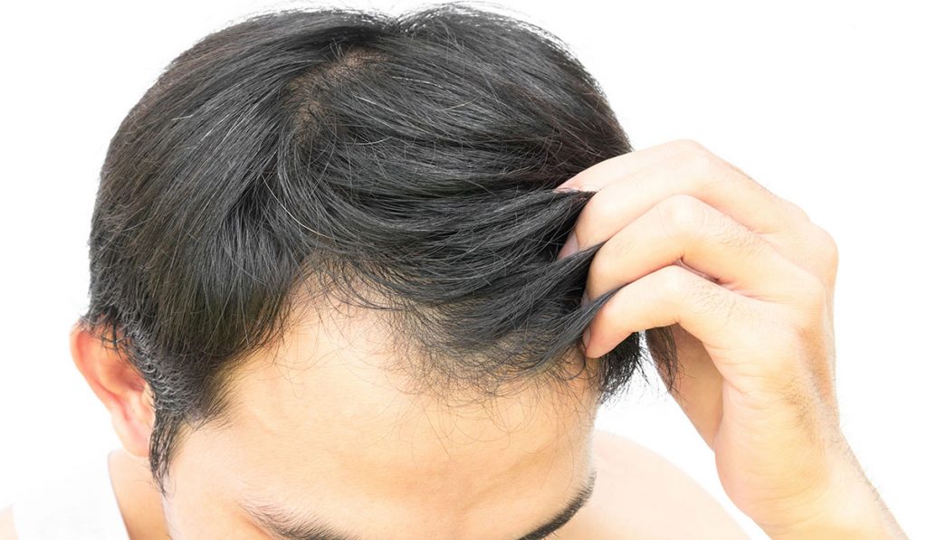 Haarausfall aufgrund von Eisenmangel
