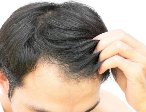 Hair Loss due to iron Deficiency
