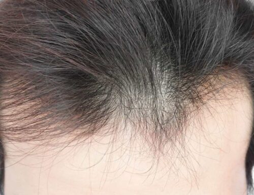 How Do You Recognize Thinning Hair