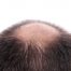 Quando l'edema passa dopo il trapianto di capelli - Zty Trapianto Capelli in Turchia