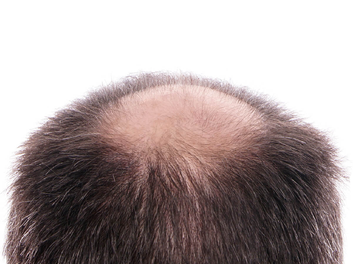 Quando l'edema passa dopo il trapianto di capelli - Zty Trapianto Capelli in Turchia