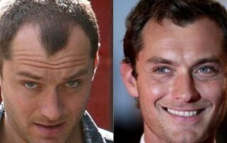 Transplantul de păr al lui Jude Law