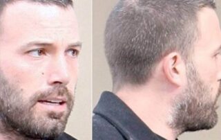 Trasplante de cabello de Ben Affleck