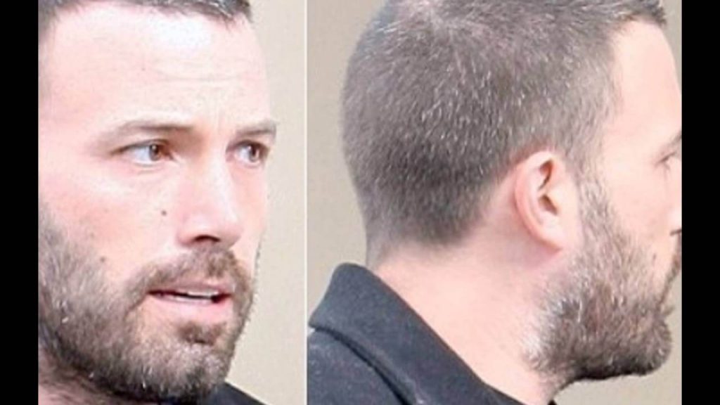 Trasplante de cabello de Ben Affleck