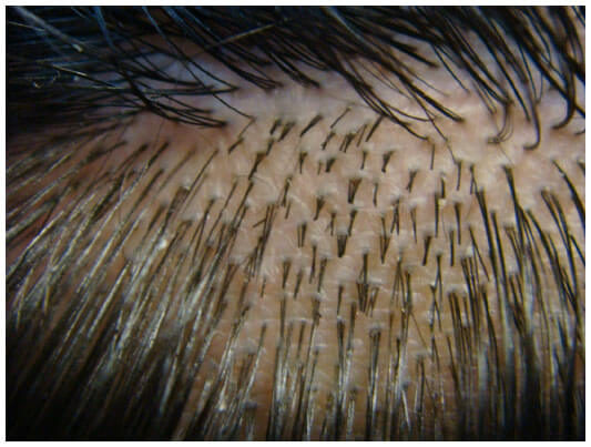 Câte Grefe sunt Transplantate în Timpul unui Transplant de Păr