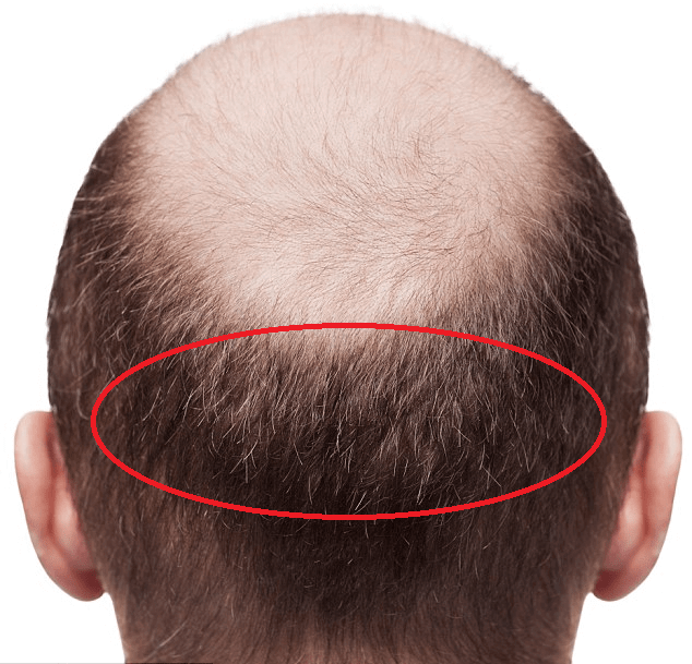 Haben Sie eine gute Spenderzone für eine Haartransplantation?