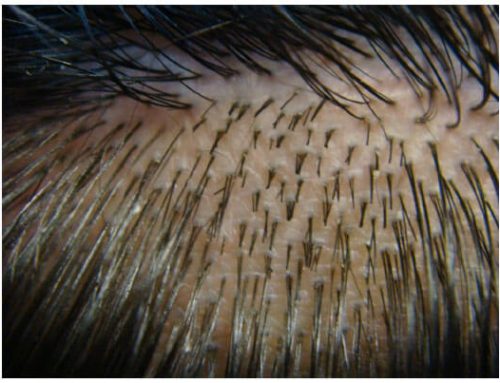 How Many Grafts are Transplanted During a Hair Transplant