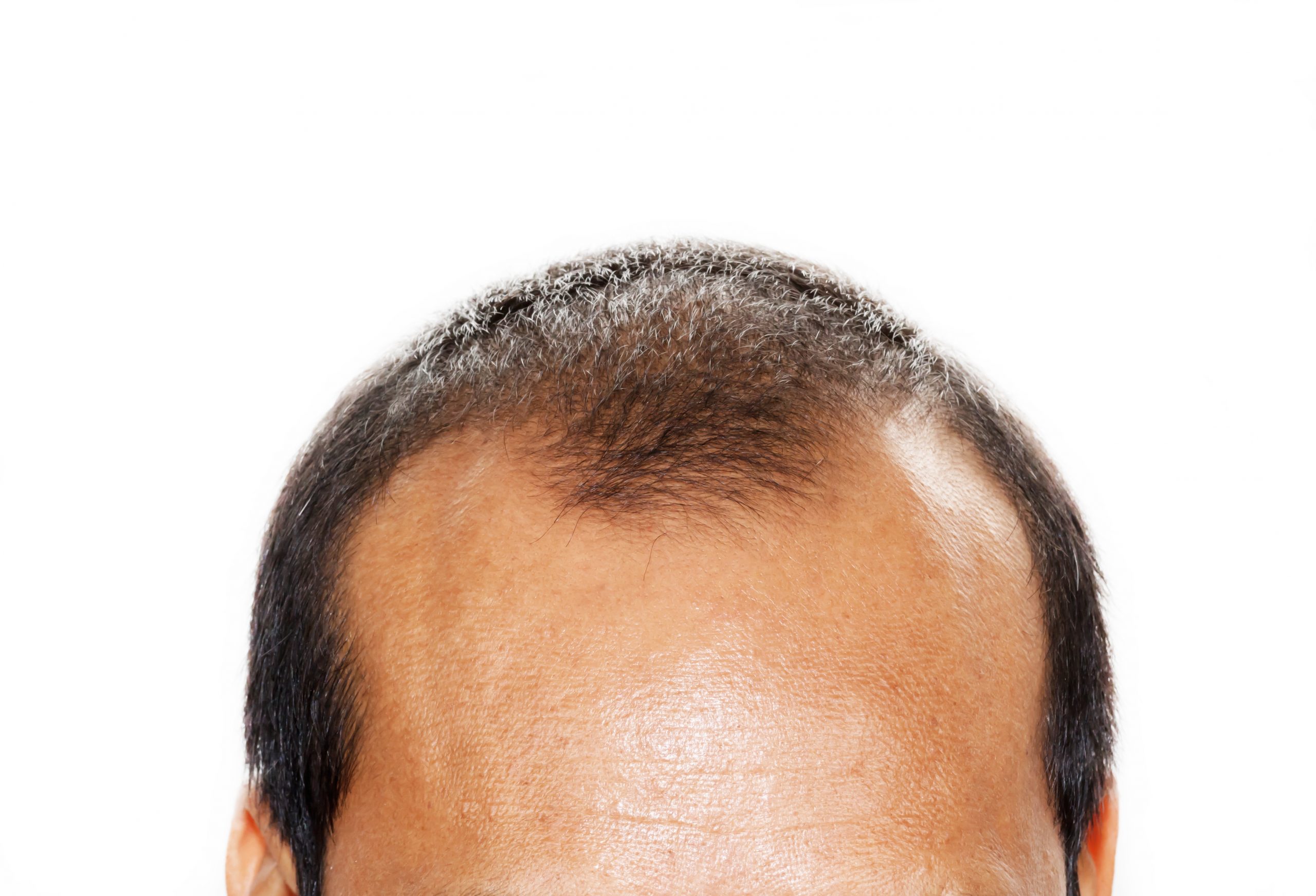 La greffe de cheveux comme protection - Zty Greffe de Cheveux Turquie