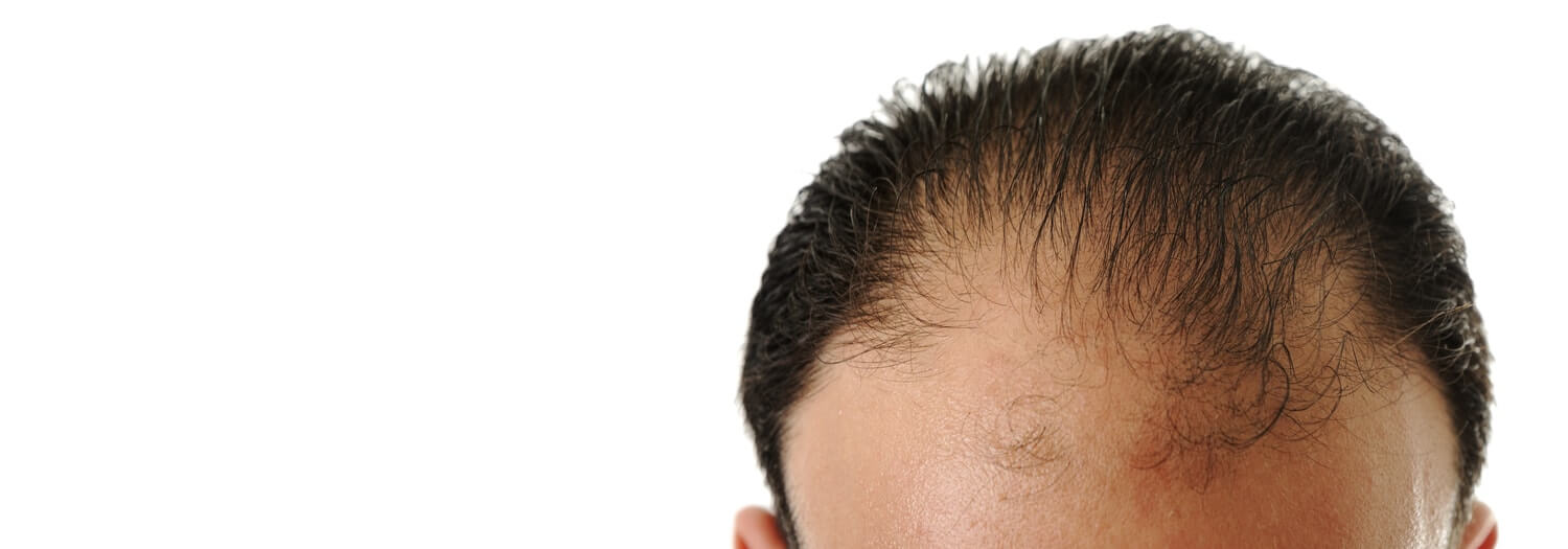 Prévenir une mauvaise greffe de cheveux - Zty Greffe de Cheveux Turquie