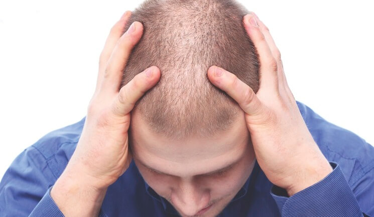 Un trapianto di capelli in giovane età può essere dannoso?