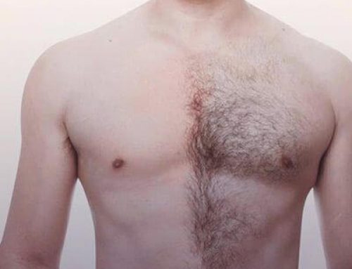 Body Hair as a Supplement for a Hair Transplant