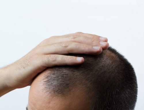 What is the ideal age for hair transplant