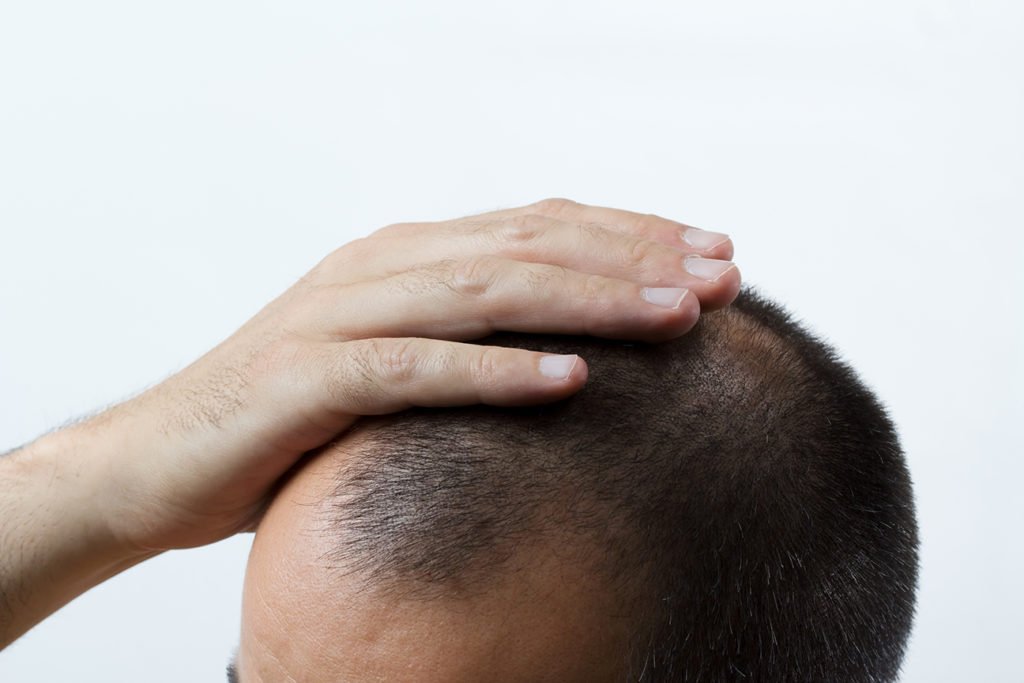 What is the ideal age for hair transplant - Zty Health Turkey