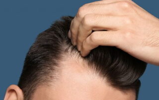 Warum ist die Türkei für Haartransplantationen bekannt?