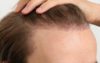 Can-You-Reverse-a-Hair-Transplant