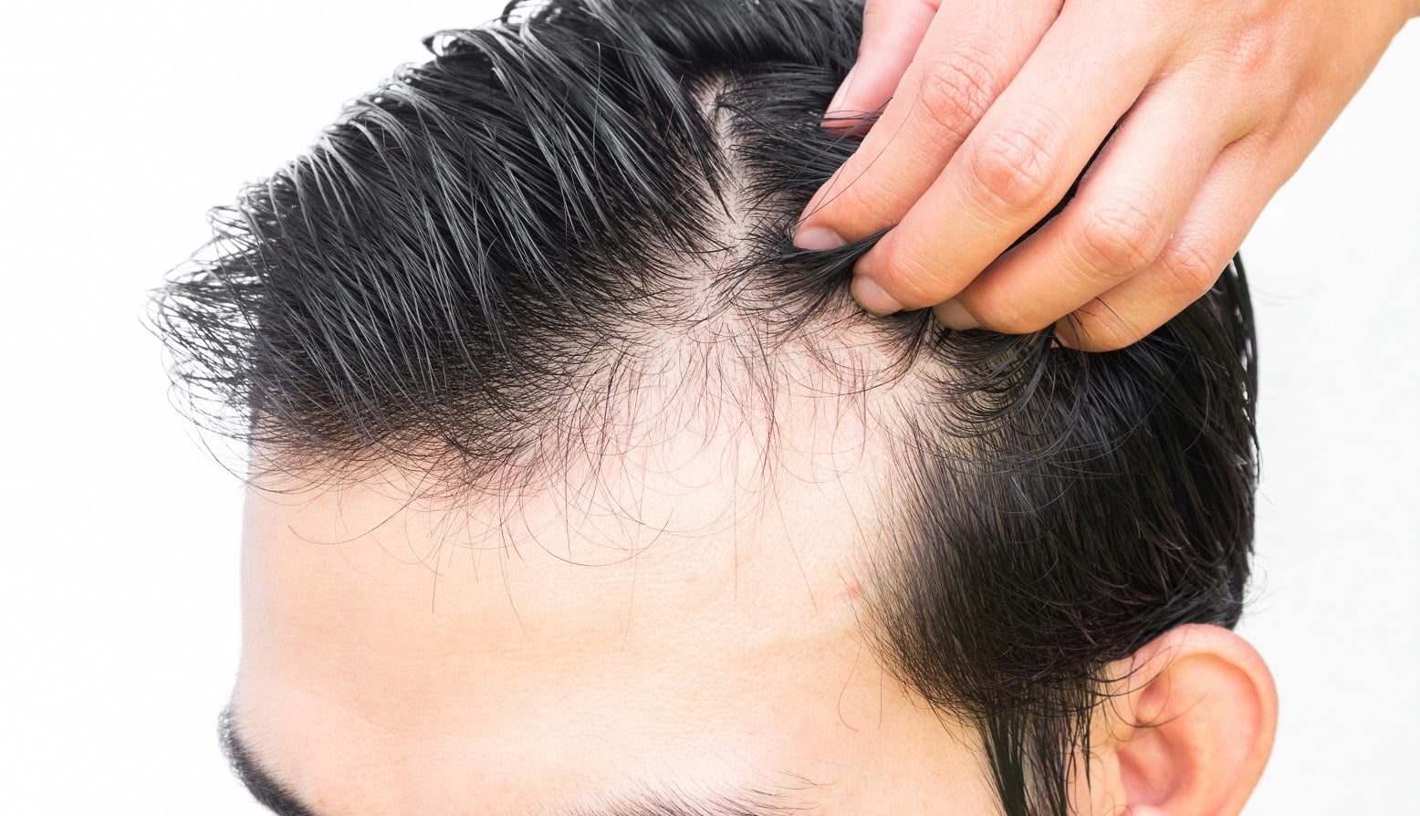 Hair transplant Repair Turkey